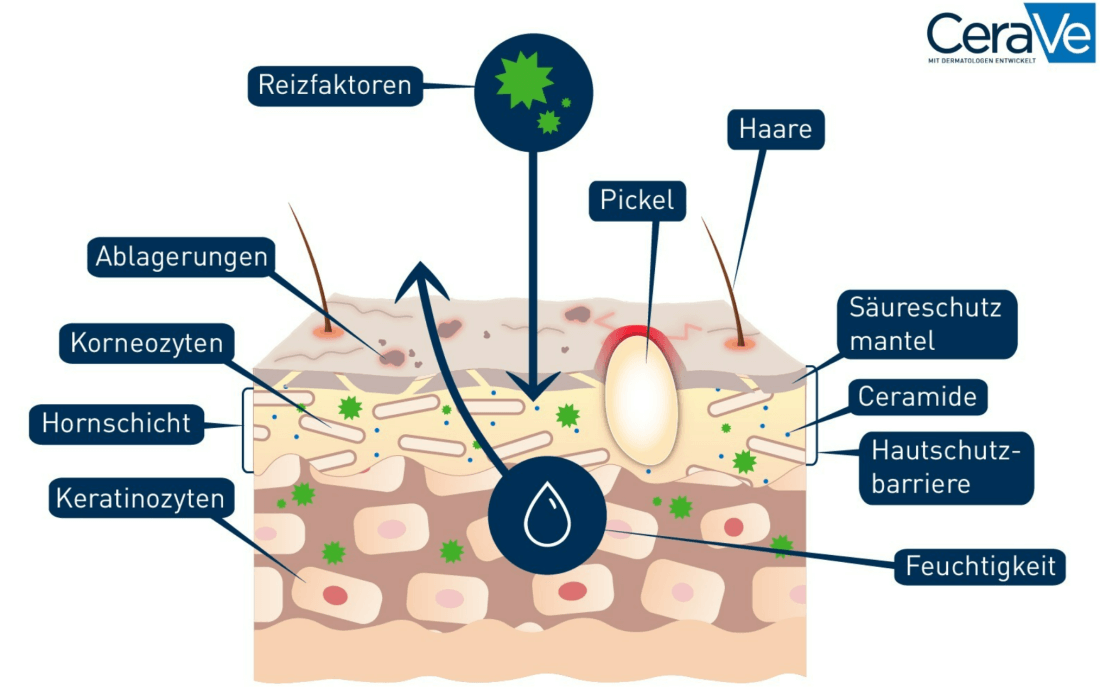 Grafische Darstellung der Hautschutzbarriere einer unreinen, zu Akne neigenden Haut